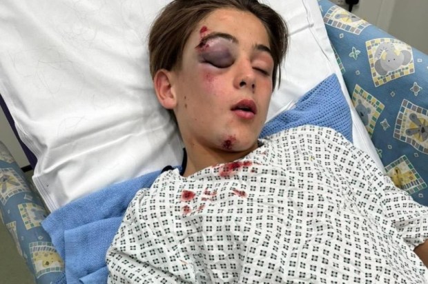 a young boy in a hospital bed has a black eye