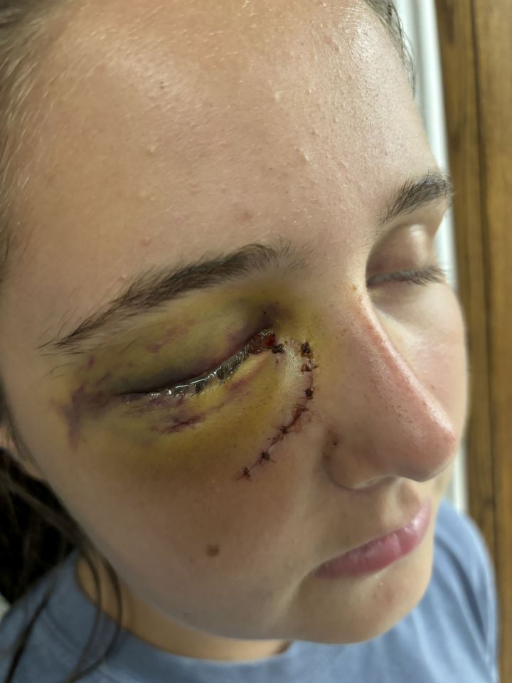 Kylie Dean was rushed to the hospital after her crash, which 'shattered' her right eye socket