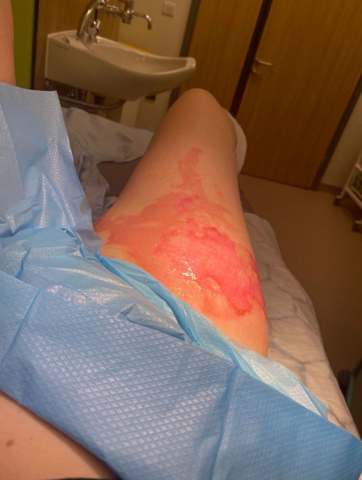 Hot pad burst releasing hot water all over her legs and vagina