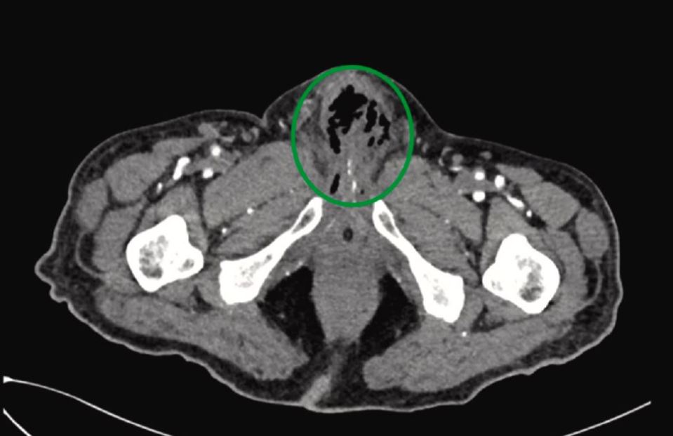 CT scan images showing the man's enlarged prostate with multiple abscesses containing gas