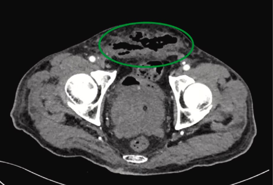 These were within the penis, pubis and abdominal wall (green oval)