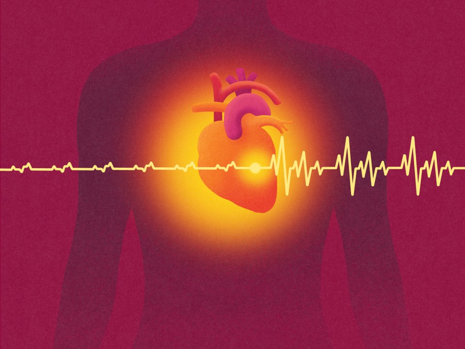 Atrial fibrillation causes the heart to beat irregularly and often very quickly