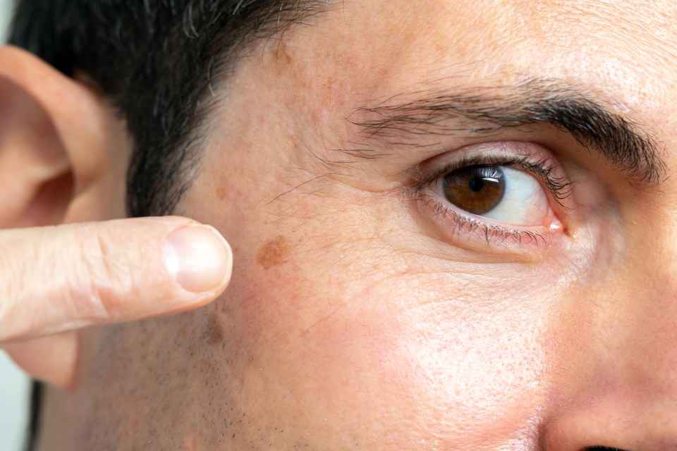 Look out for moles or lesions on your partner - that they may have missed or ignored