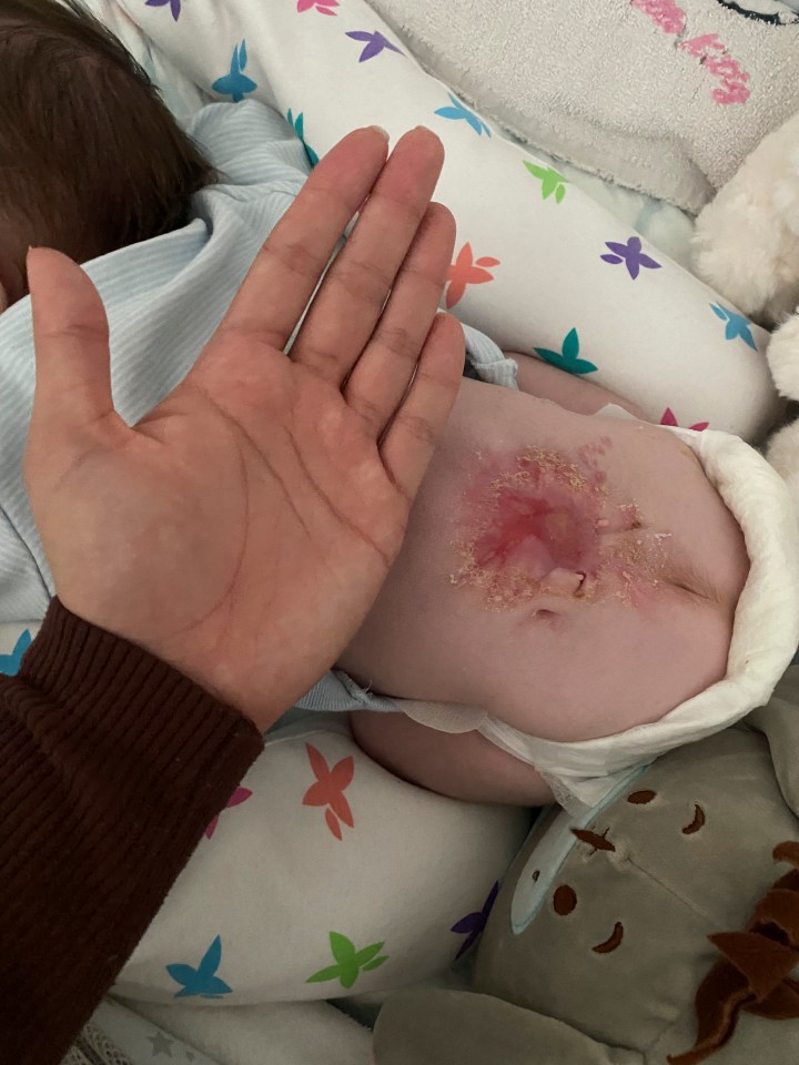 a person holding a baby 's belly with a rash on it