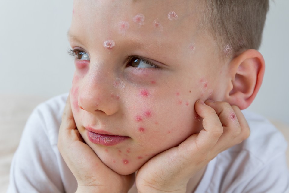 a young boy with red spots on his face