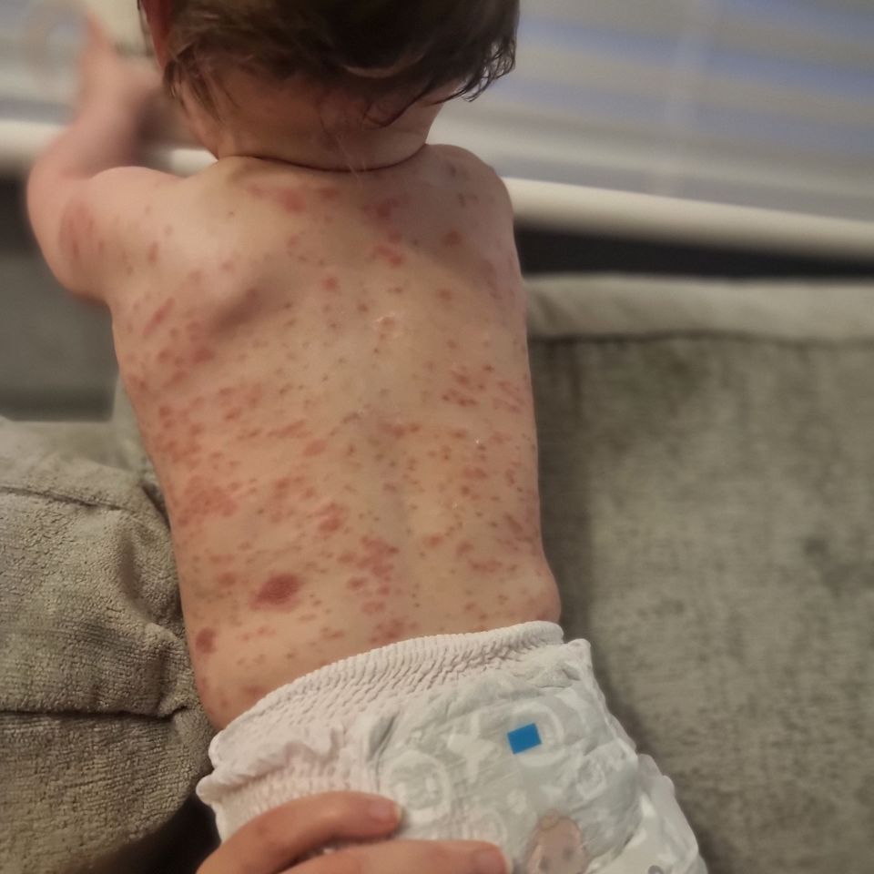 The tot began breaking out in rashes across her back and chest when she was 3 months old