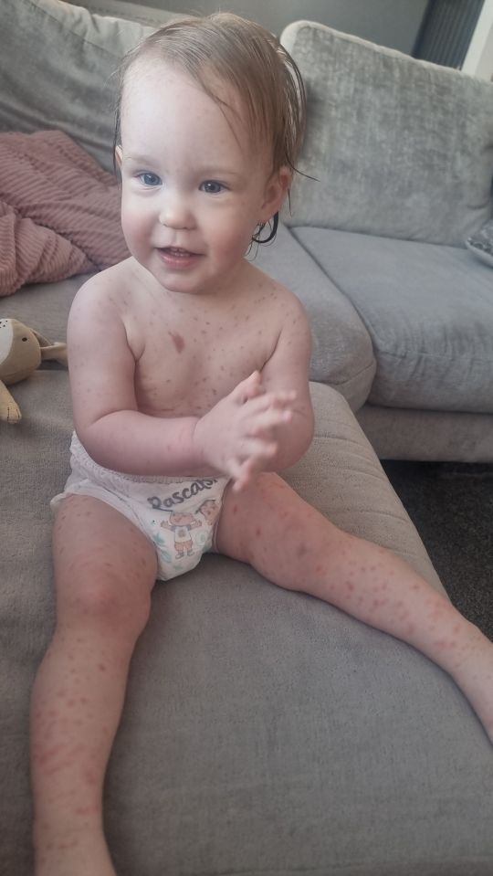 She was finally diagnosed with mastocytosis at 17 months old