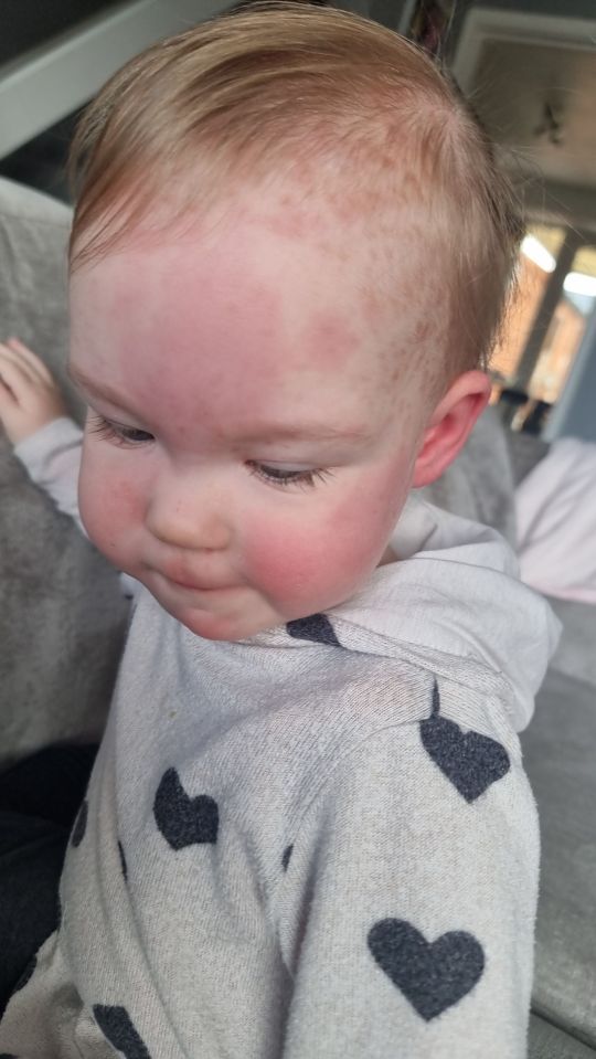 Willow-Rae Smith, 1, has a rare condition that makes her allergic to ticking, cuddling and being excited