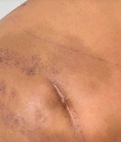 a close up of a person 's back with a scar on it .