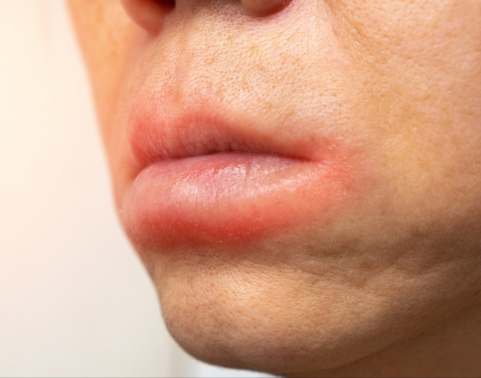 Suddenly developed a full pout - it could be a kissing allergy