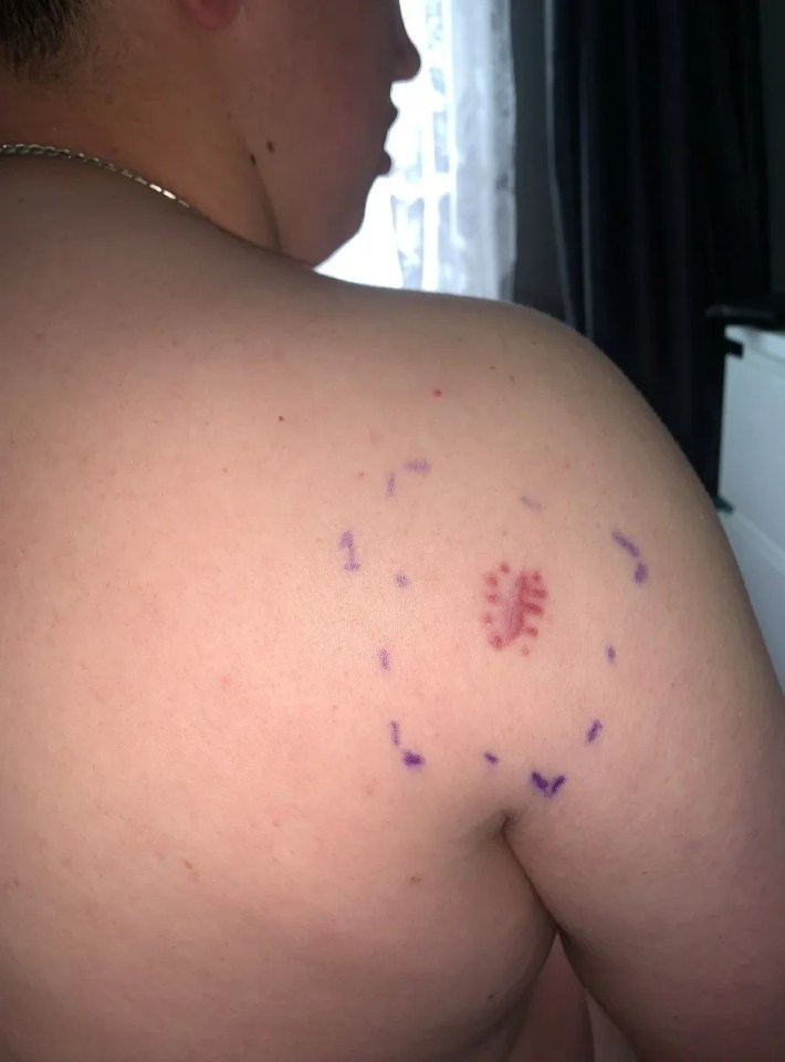 Ben noticed an an itchy lump on his back that was at first mistaken for  ringworm or a tattoo ink allergy