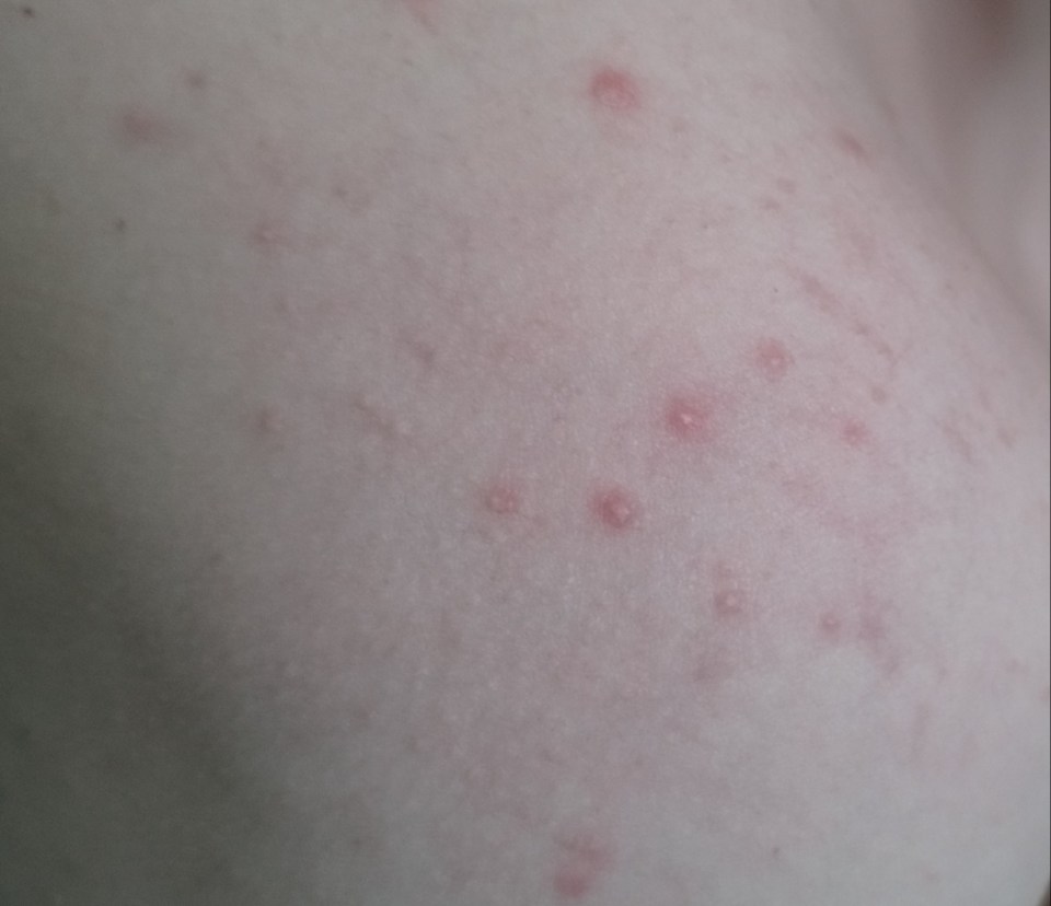 a close up of a person 's back with red spots