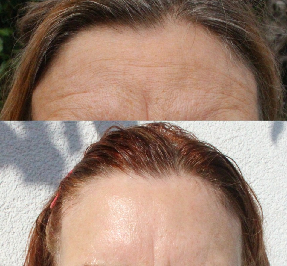 a before and after photo of a woman 's forehead