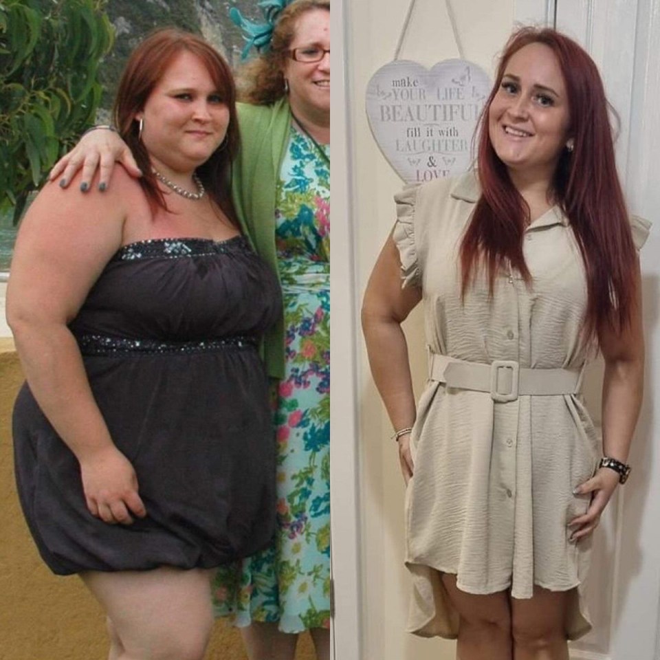 Louise successfully lost eight stone after weight loss surgery