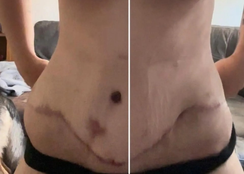 a woman 's stomach is shown before and after surgery