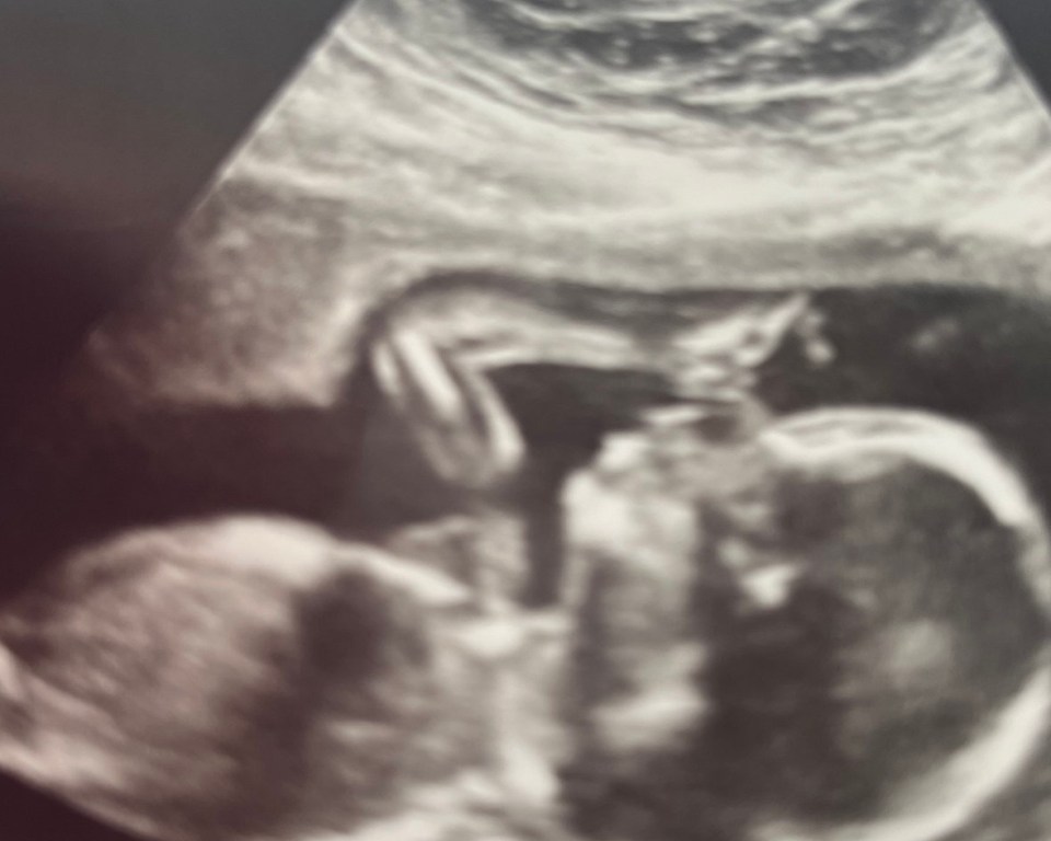 Weeks later, a routine scan revealed Farron's unborn baby was unwell