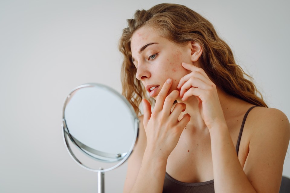 Around three per cent of adults over the age of 35 have acne