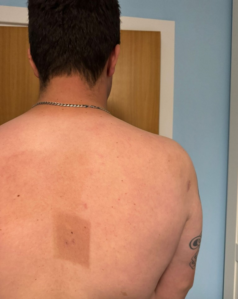 A tanned patch on Ben’s back following radiotherapy treatment