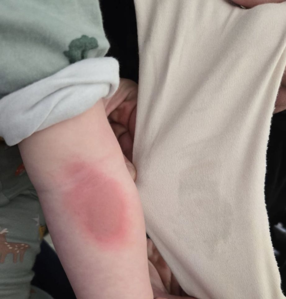 Rosie found a grease-like stain on the arm her son's sleepsuit in the same spot where the burn was