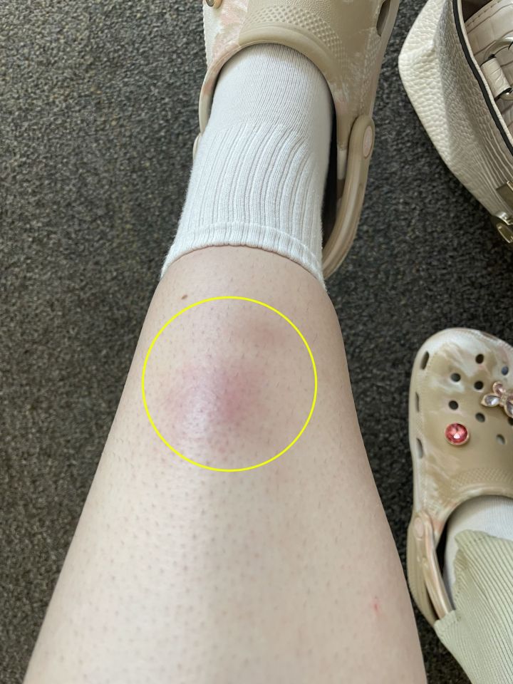 The 27-year-old dismissed a mark on her leg for eczema