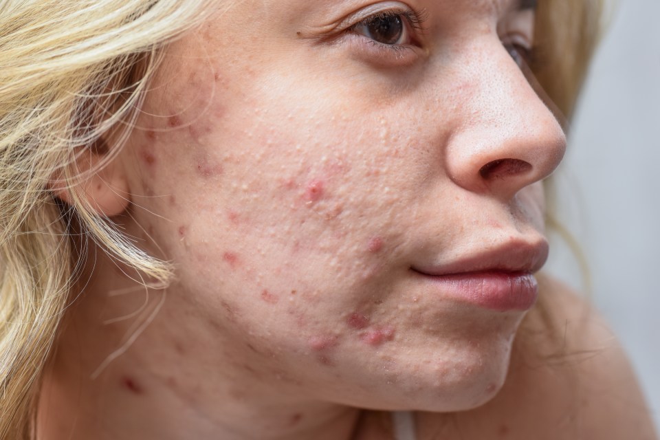 Cystic acne is considered a severe form of acne, and is the most likely to cause scarring