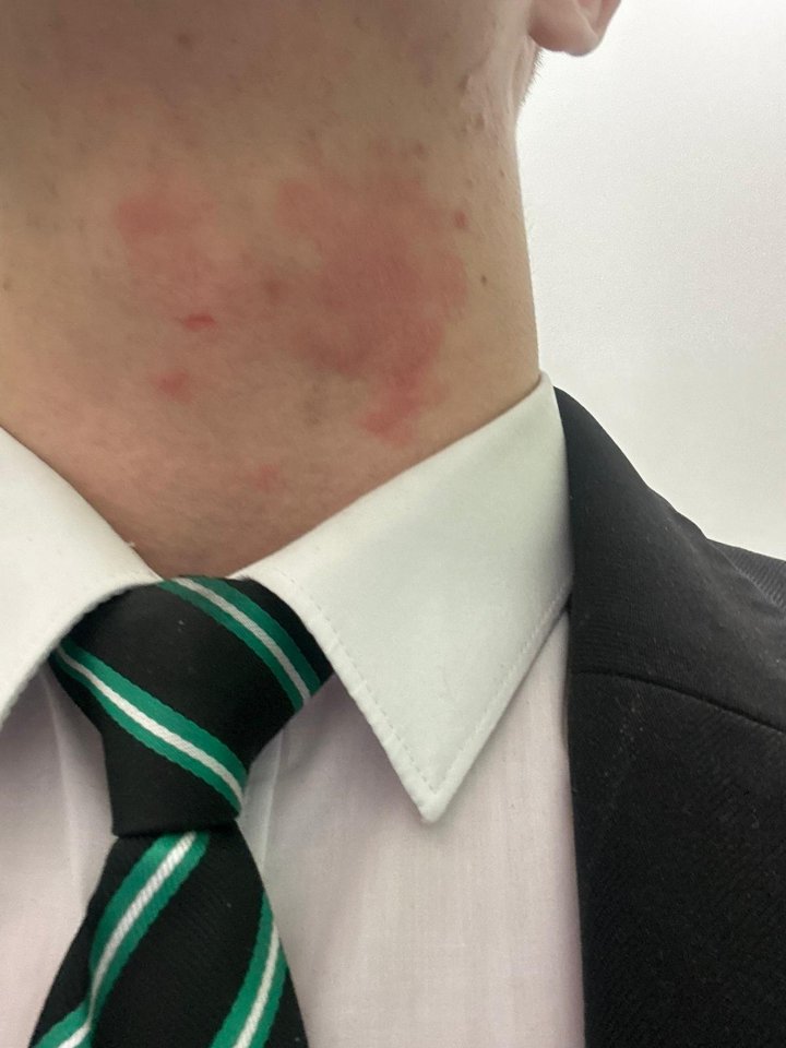 Liam's eczema. A headteacher has defended his school's strict haircut policy after one pupil's skin fade for his severe eczema was deemed too 'extreme'. Strood Academy headteacher Jon Richardson says their haircut policy aims to bring 'equality and focus' to pupils at the Kent school. But 15-year-old student Liam's parents have branded his removal from class and placement in a behavioural unit due to his skin fade - which he wears to cool his head due to his eczema condition - 'ridiculous'. The school's policy states: No extreme haircuts. eg: Skin fades, graphics, lines and must be a minimum of grade one cut (senior leadership teams discretion)."