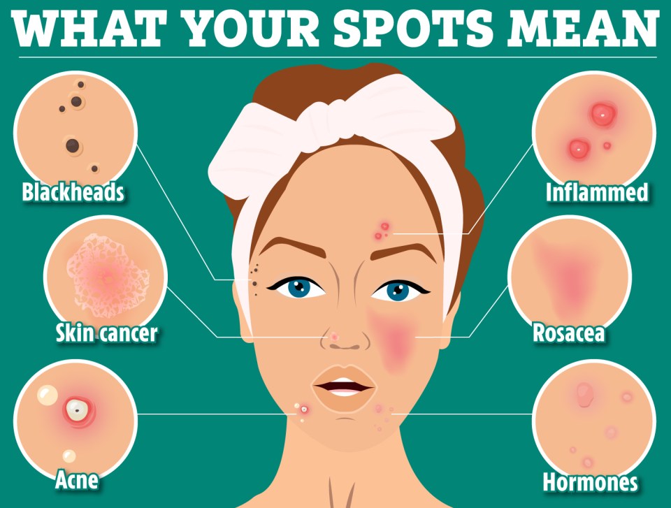 We reveal the most common types of spots, their causes and how best to treat them