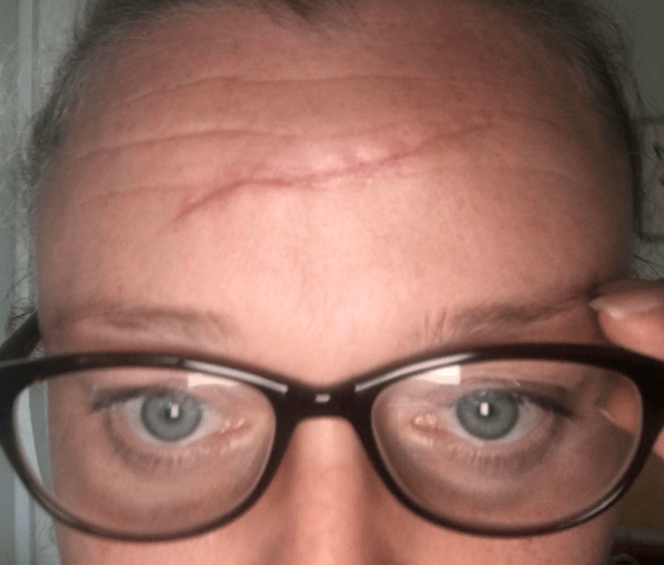 a woman wearing glasses has a scar on her forehead