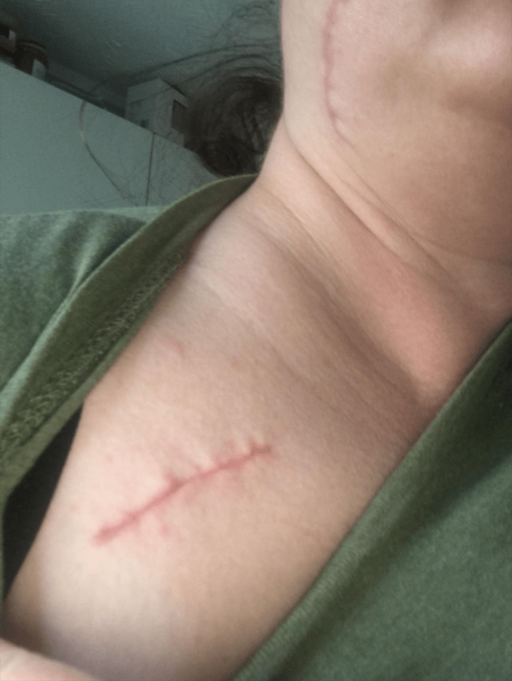 a woman has a scar on her neck and chest