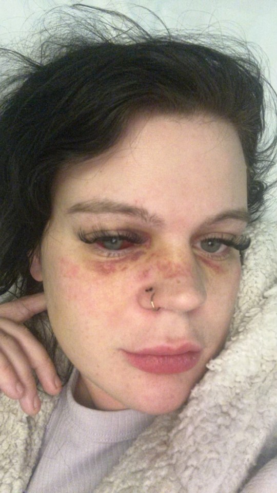 She suffered a number of injuries including a fractured eye socket