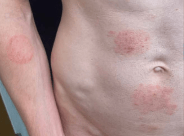 The fungal rash can emerge on the genitals, buttocks, face and trunk (Credit: CDC)