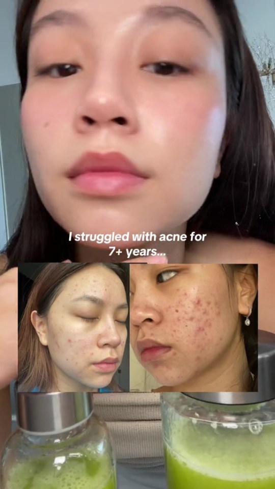 Thuytien, pictured, had suffered with acne for seven years before transforming her skin