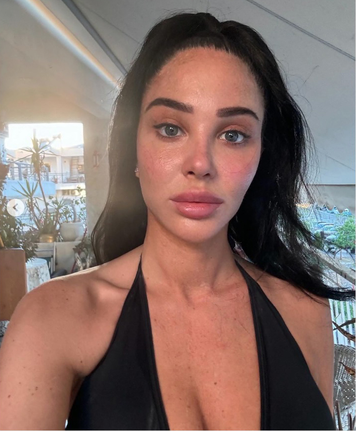 Tulisa has battled chronic inflammation and swelling in her face. She is pictured in June 2024