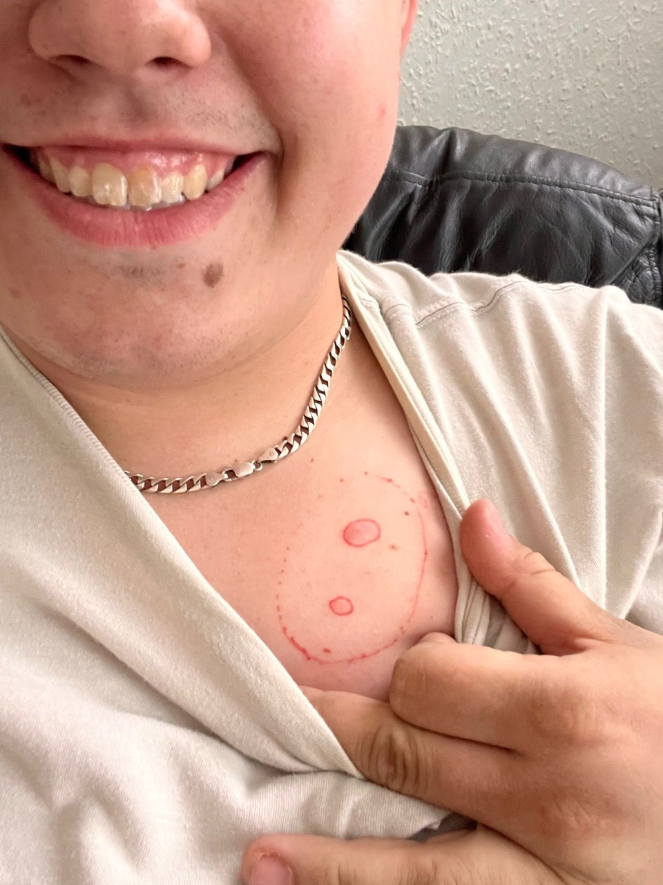 Ben initially spotted two lumps on his chest which were benign