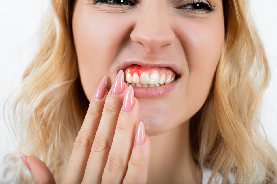 Swollen, bleeding gums is one of the symptoms of scurvy to look out for