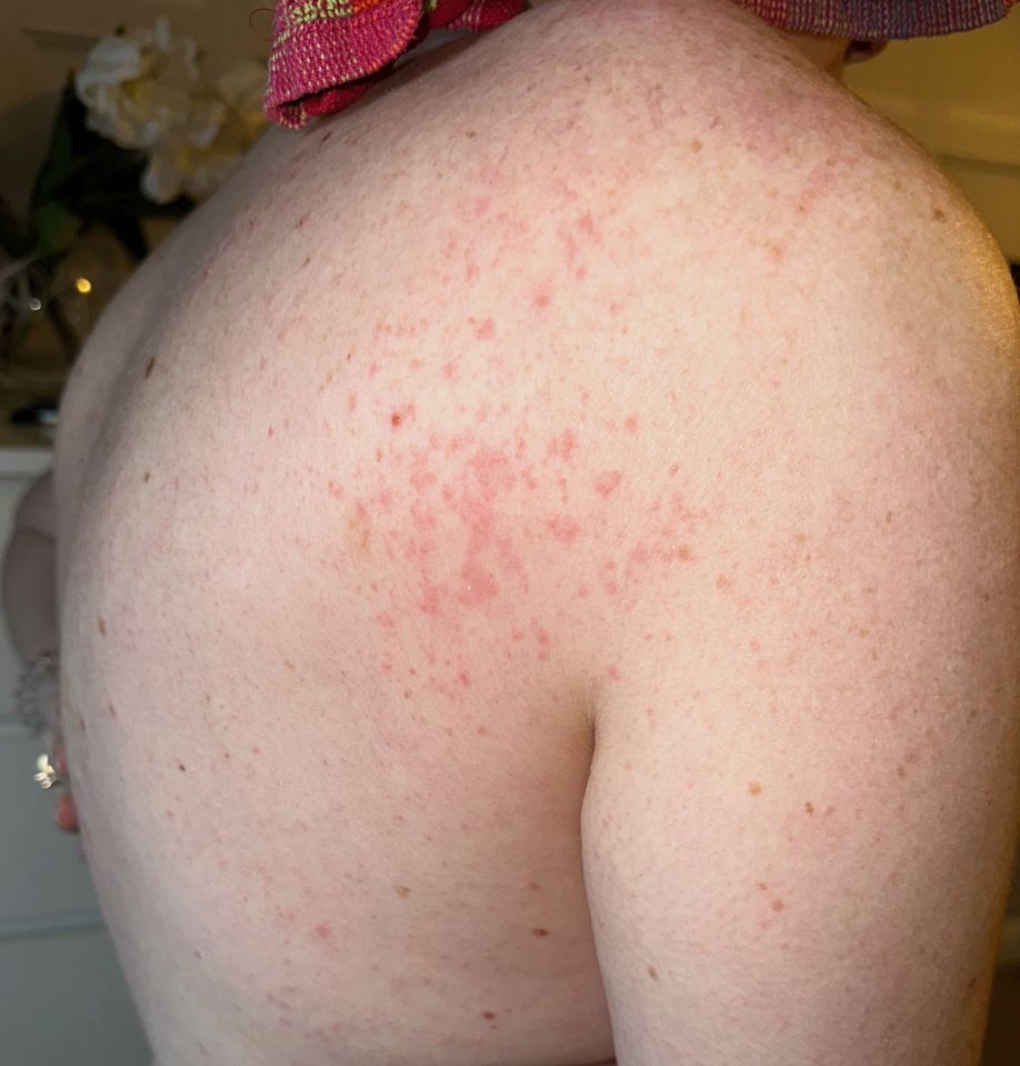 a woman 's back has a lot of red spots on it