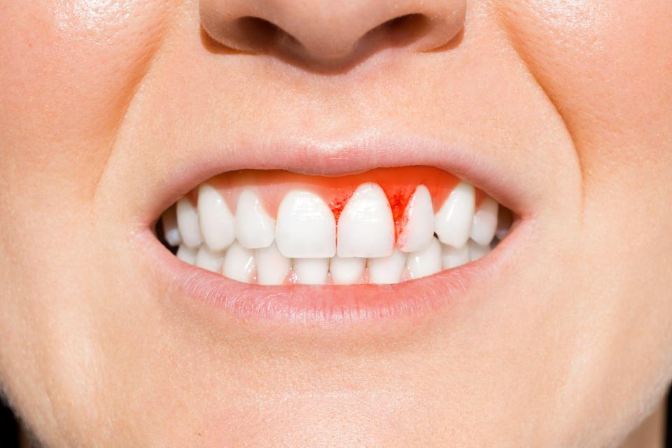 Scurvy can cause worrying symptoms like bleeding gums and red or blue spots on the skin