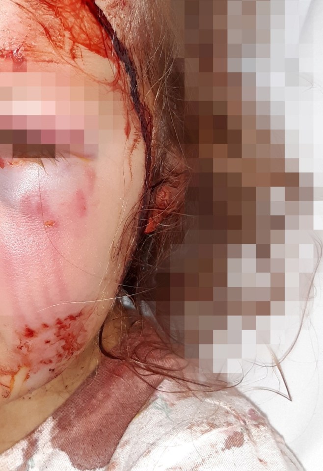 A little girl suffered brutal injuries after she was mauled by the family dog