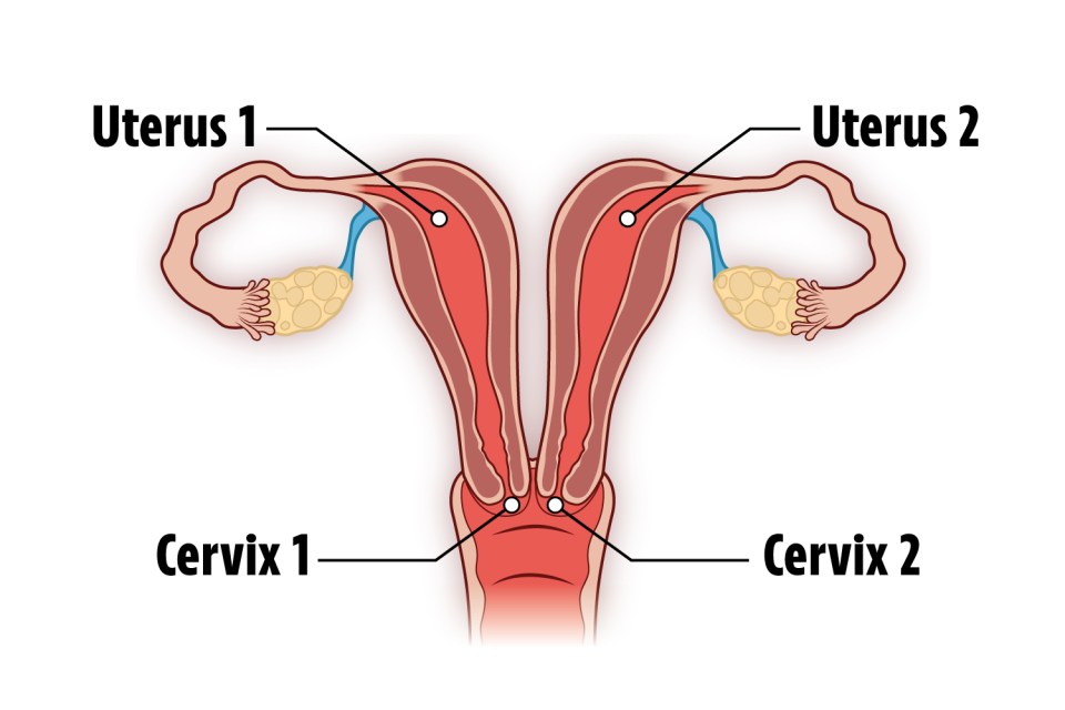 Diagram shows a uterus didelphys