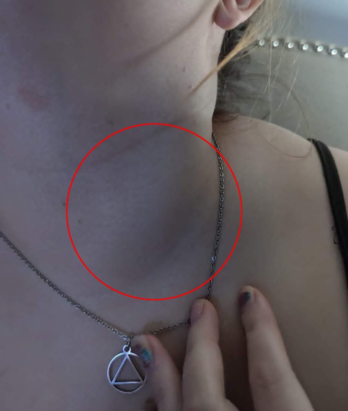 The now 32-year-old visited a doctor after discovering a lump on her neck