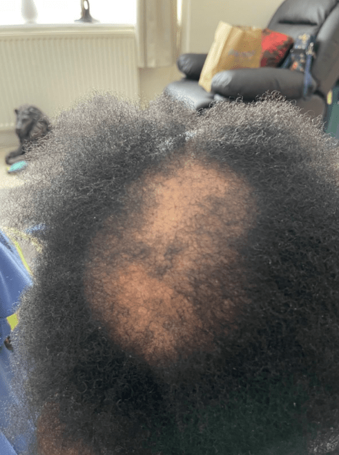 One woman showed how she had hair loss before using the oil