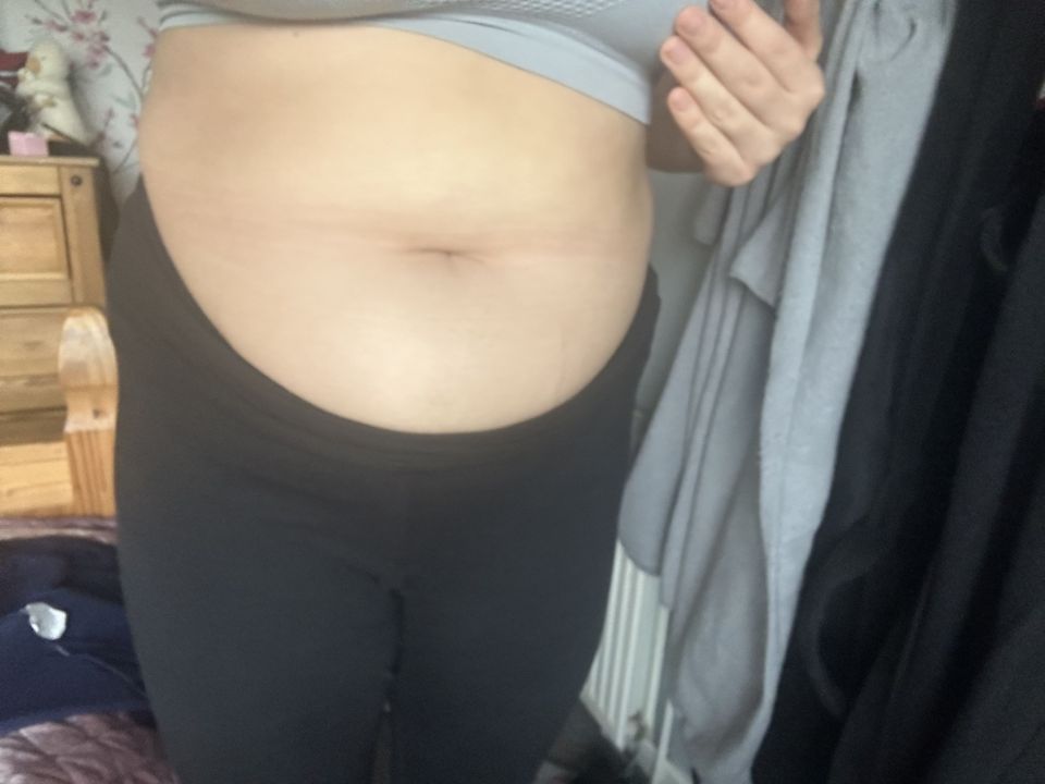 Concerned about a 'big bloat' on her belly, she sought out a gynecologist but needed to lose weight to get a referral