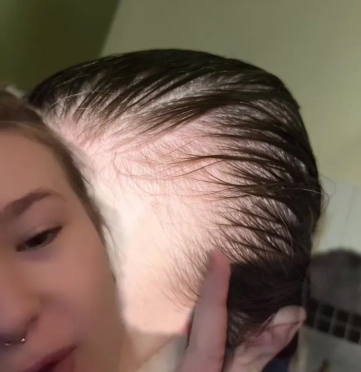 TikTok user Shan showed her followers her hair loss before she began using her secret weapon