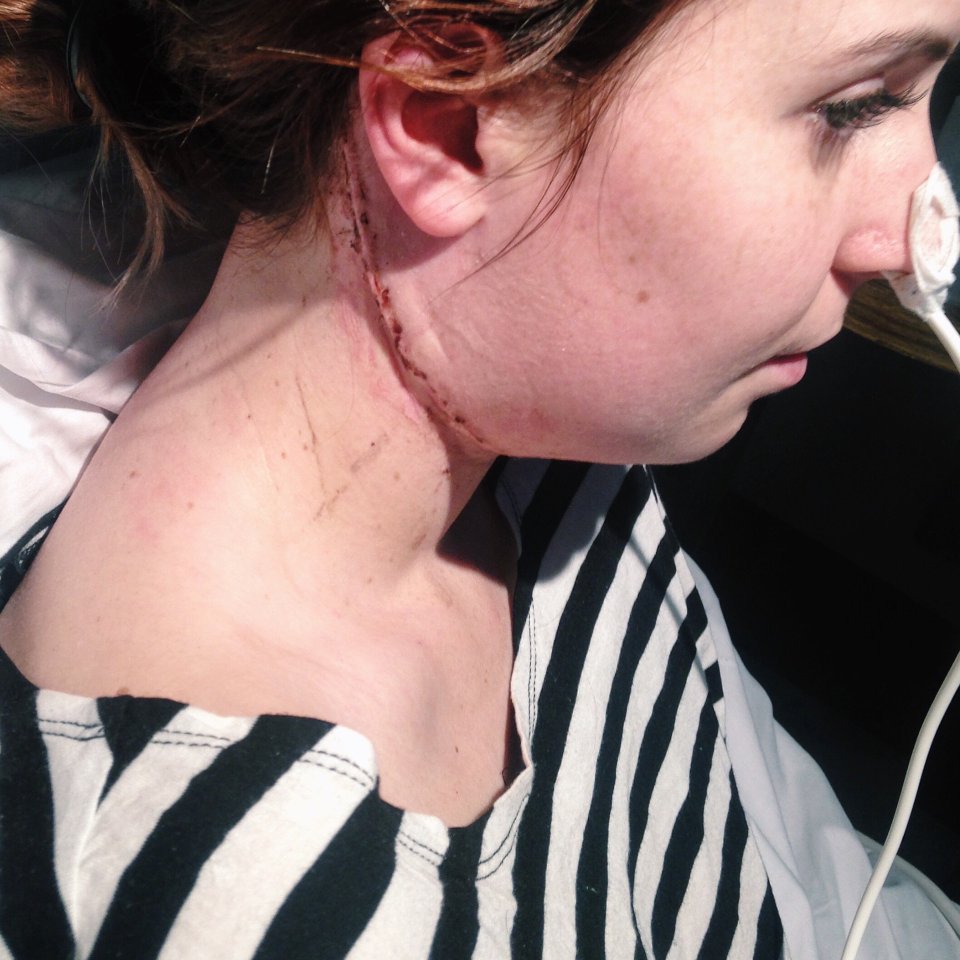 Doctors cut a “huge” lump out of the nanny’s neck and grafted part of her nerve to her ear