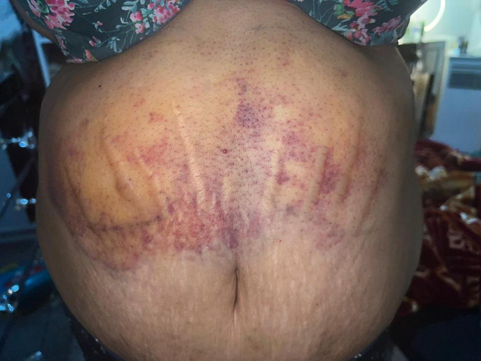 One patient has told how she was left scarred and in agony following the procedure