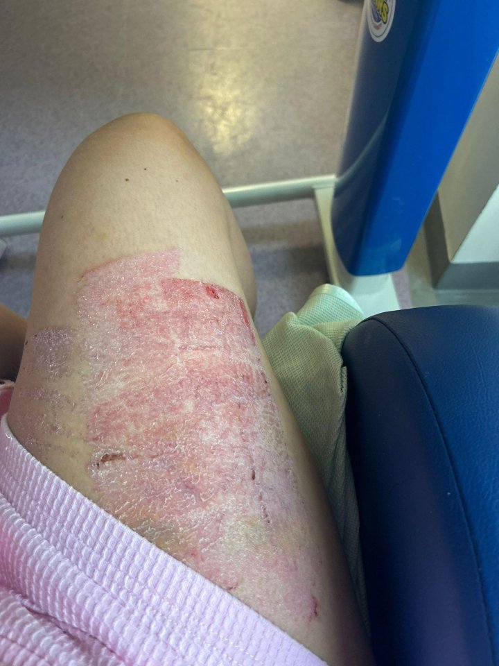 Her two-year-out-of date hot water bottle exploded and left her with second degree burns