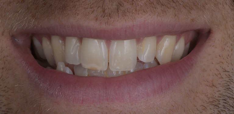 Stress-induced teeth grinding can wear your gnashers down