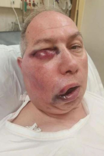 Headline: Cricket umpire left unrecognisable after horror facial injuries but says he 'feels like he won lottery',