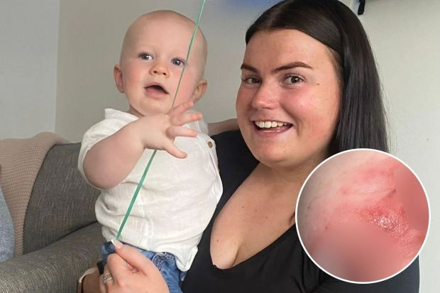 a woman holding a baby next to a picture of a rash on her arm