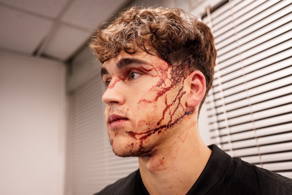 Pau Cubarsi suffered horror facial injuries after being studded in the face